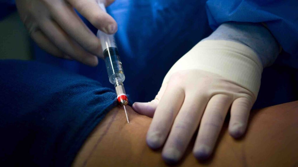 PACU