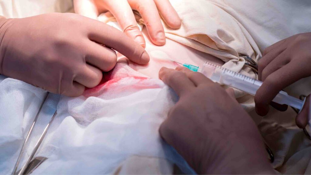 PACU